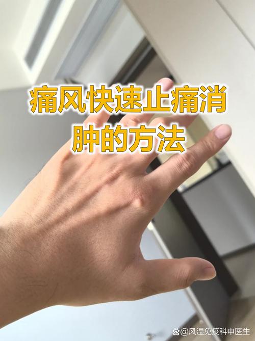 痛风病人可以吃浆水吗