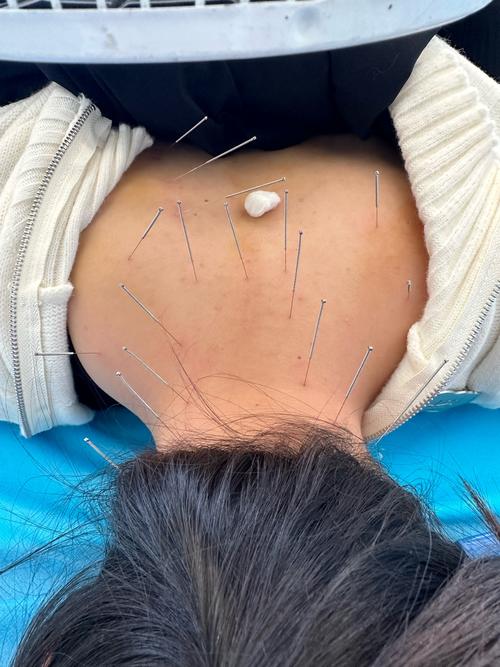 扎针灸为什么越来越疼