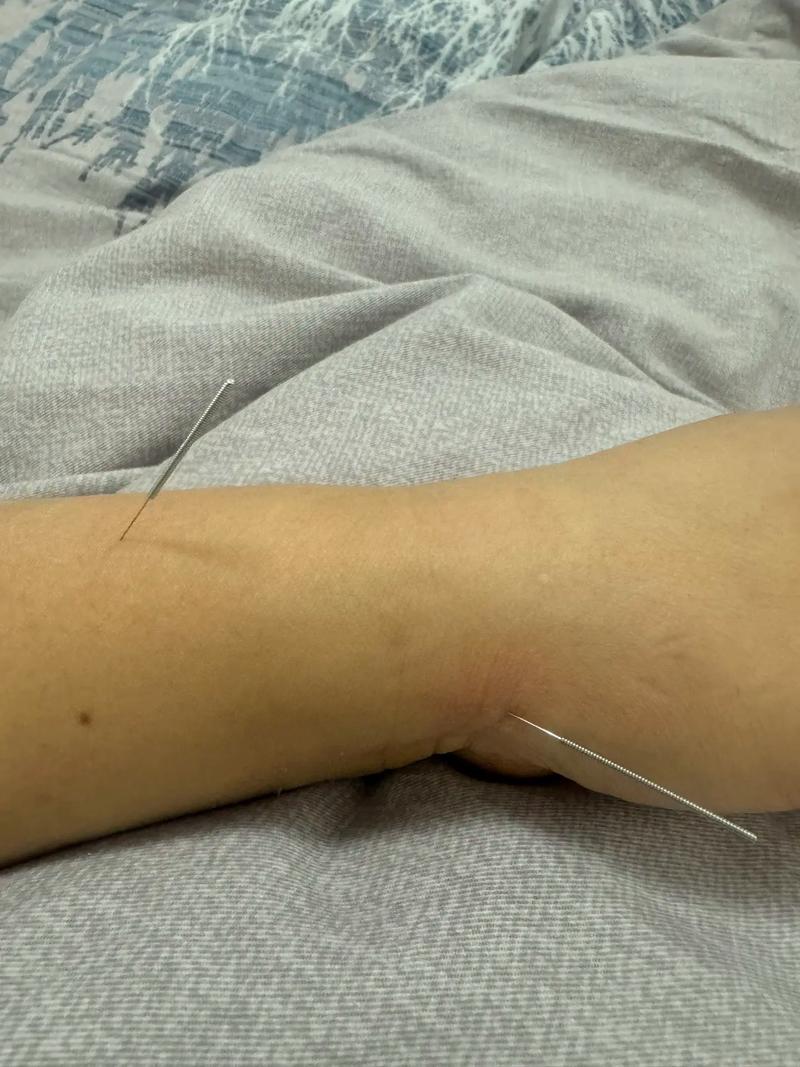 针灸后针感太强怎么办