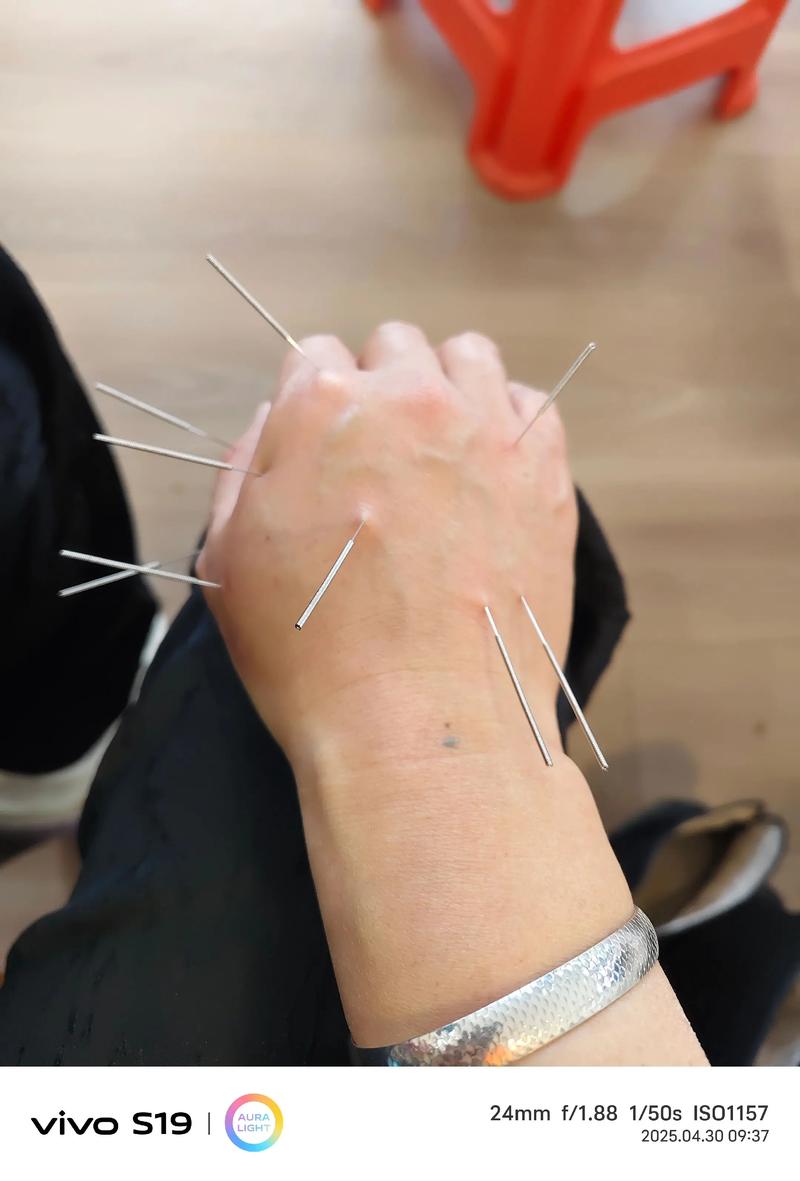 腕管综合征可以针灸吗