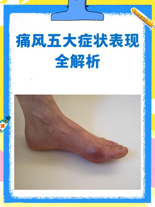 痛风的特征性临床表现