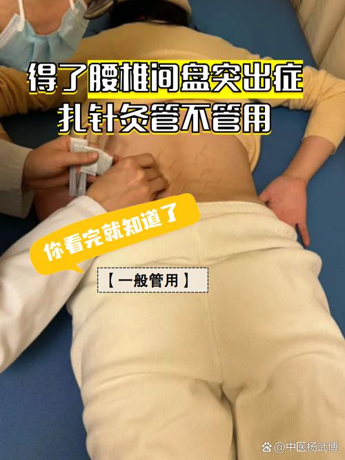 针灸可以治腰间盘突出