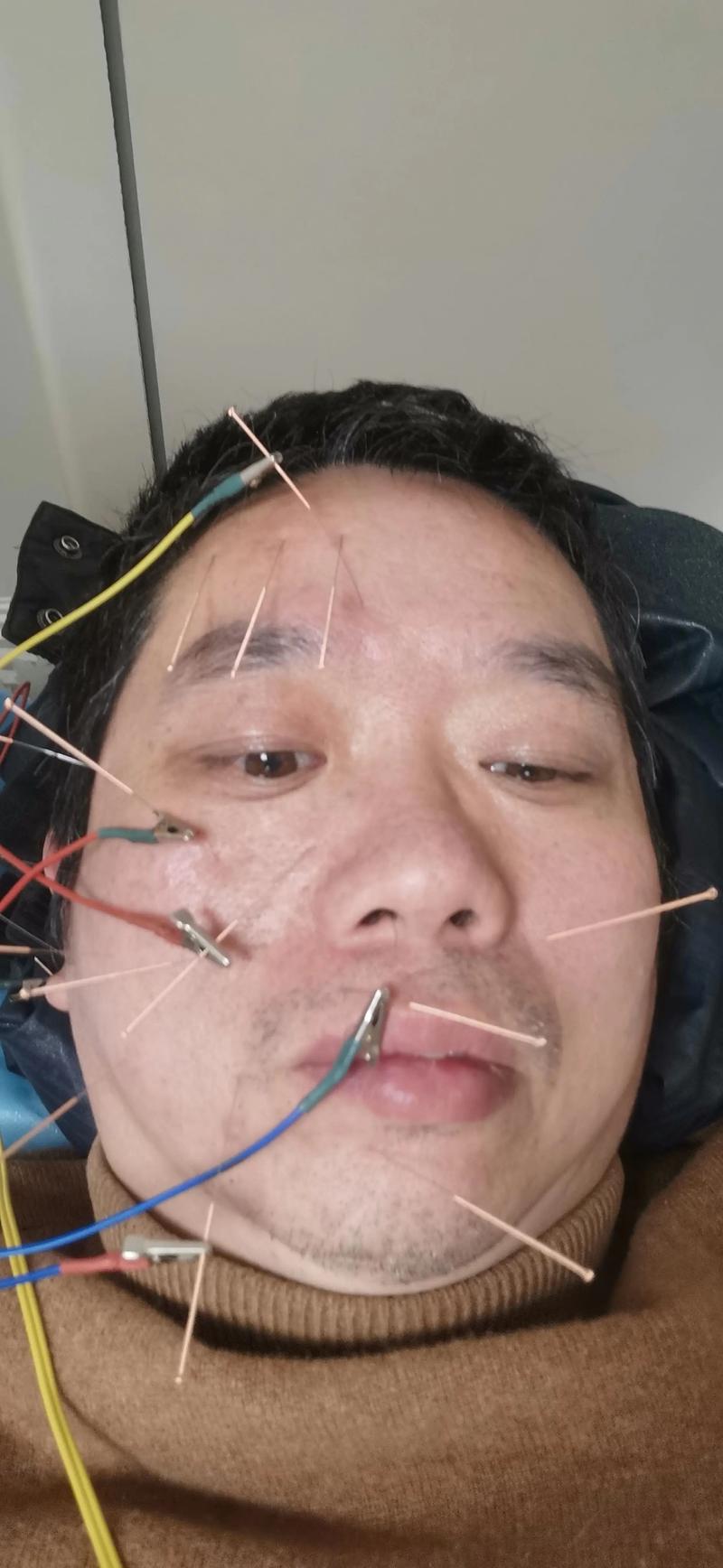 面瘫针灸会留后遗症吗