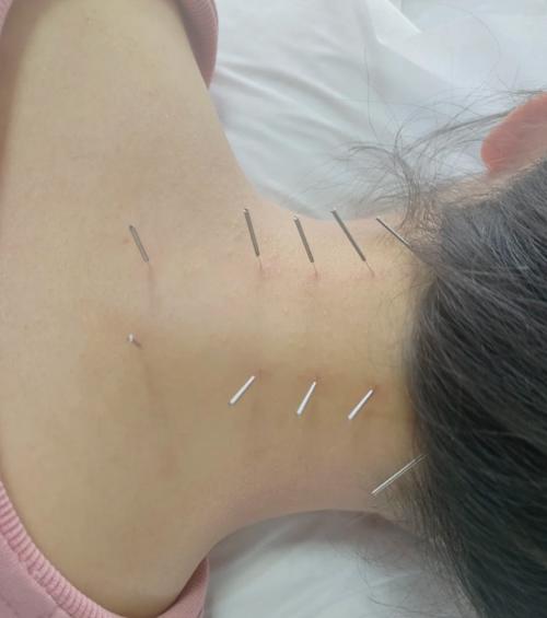 针灸后受凉是什么样的