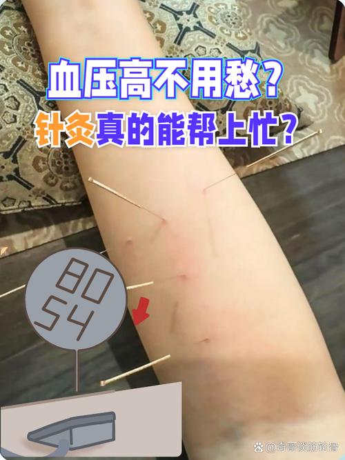 针灸后血压高怎么回事