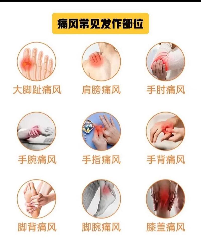 痛风关节炎症状及治疗