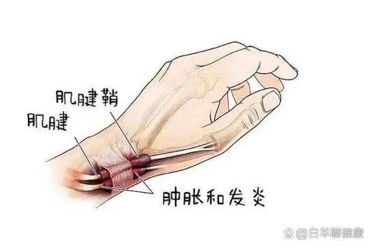 腱鞘炎可以针灸治疗吗