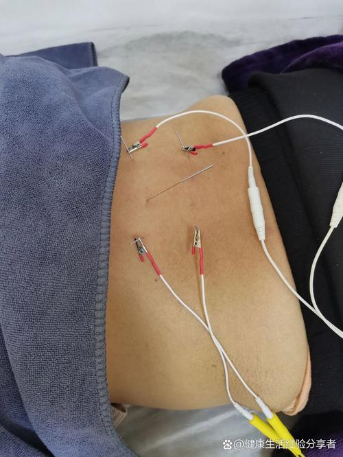 电灸和针灸哪个效果好