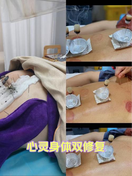 电灸和针灸哪个效果好