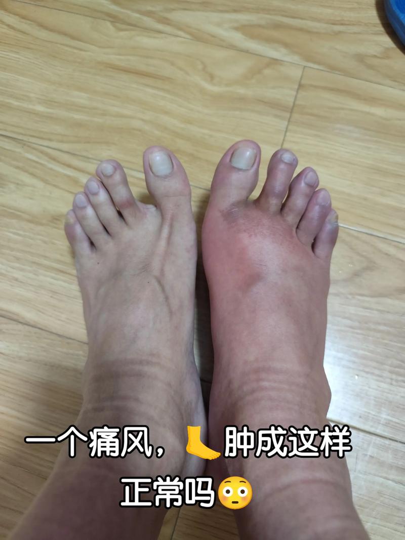 痛风不痛了但是不消肿