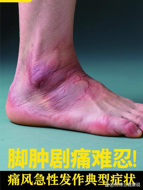 痛风不痛了但是不消肿