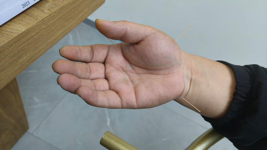 静脉曲张扎针灸管用吗