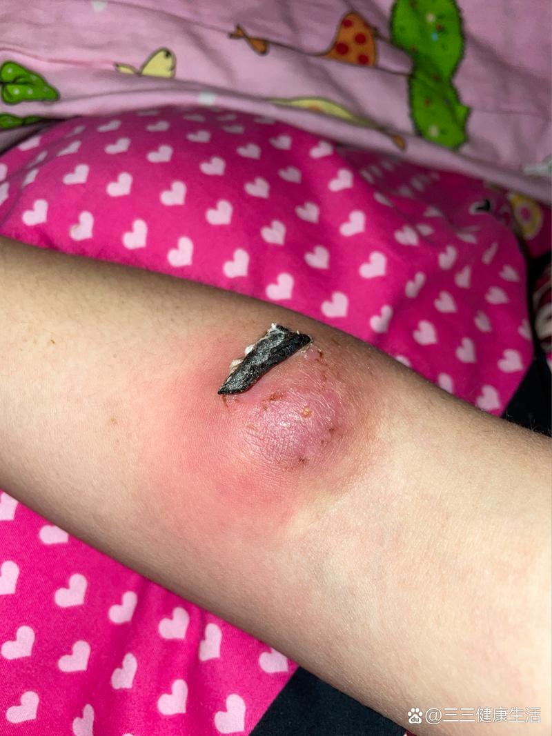 针灸之后有个疙瘩还痛