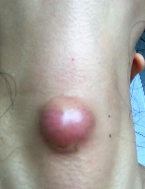 针灸之后有个疙瘩还痛