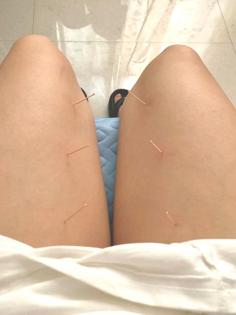 针灸之后有个疙瘩还痛