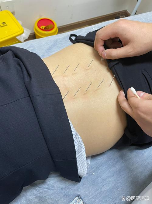 腰椎间盘突出针灸部位