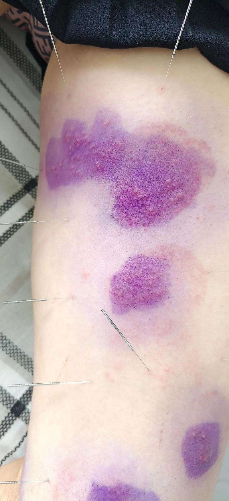 带状疱疹针灸怎么治疗