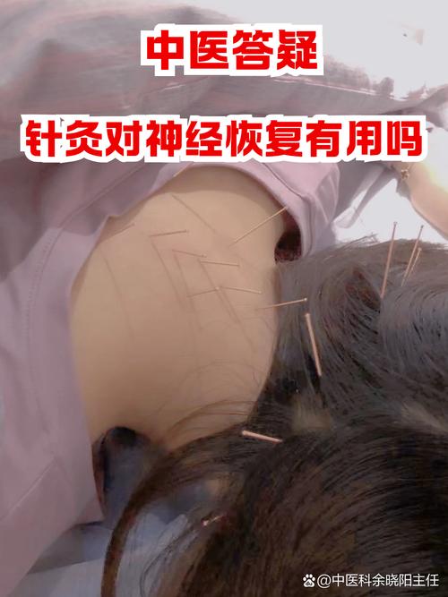 针灸治疗抑郁症易复发