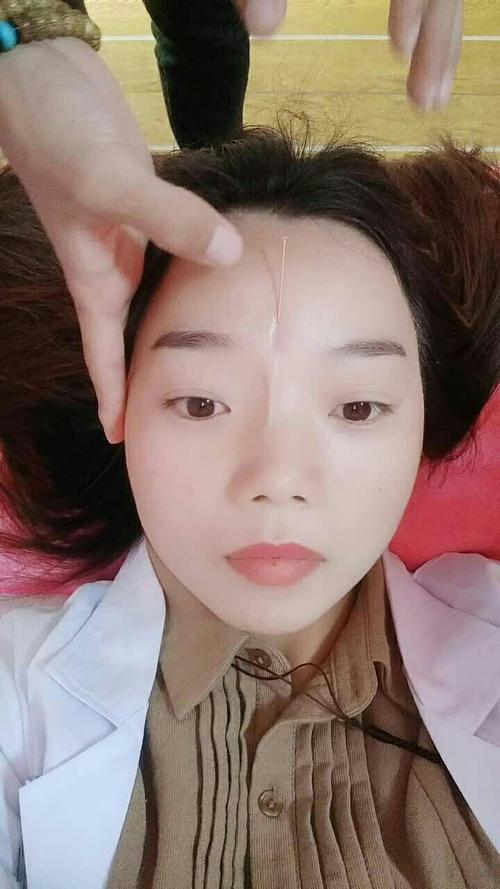 针灸隆鼻的效果好不好