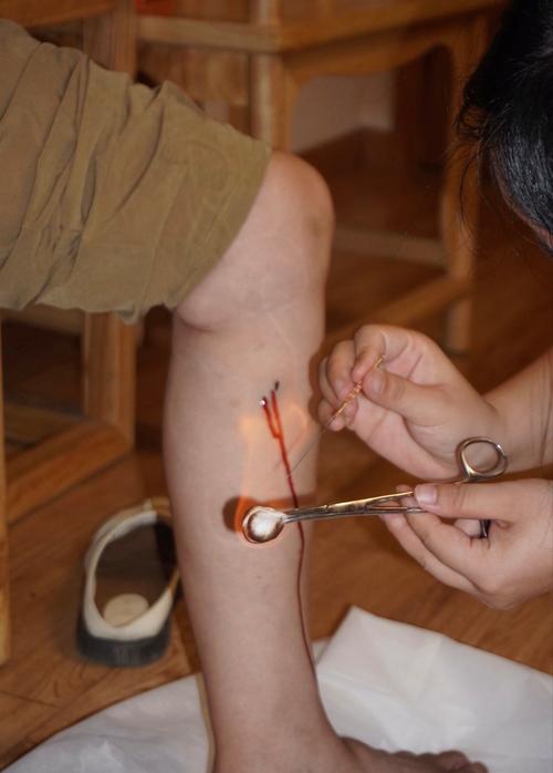 针灸小腿后筋疼正常吗