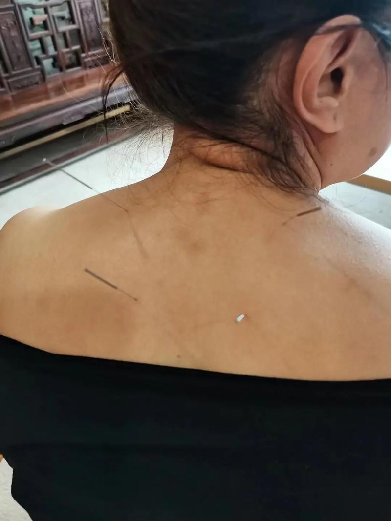 腰疼扎针灸有副作用吗