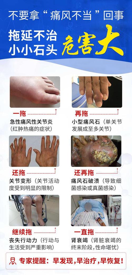 慢性痛风的症状及治疗