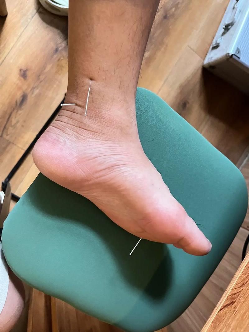 脚上针灸后可以泡脚吗