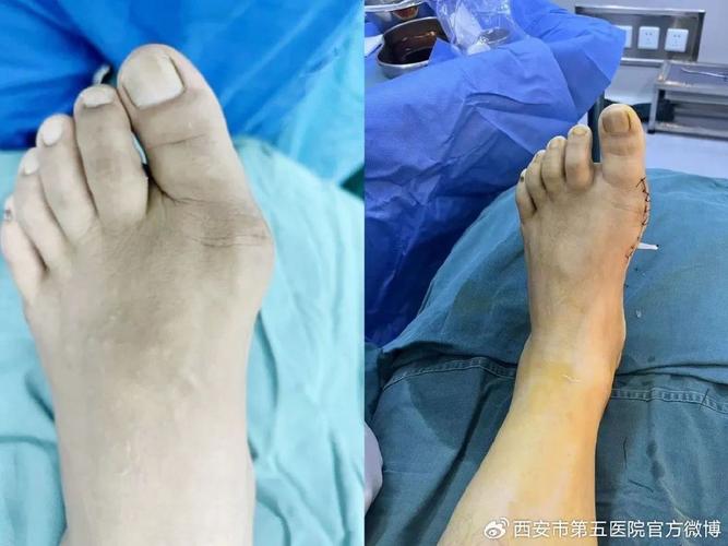 西安第五医院治疗痛风