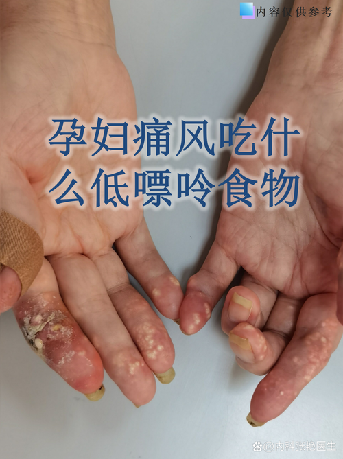 痛风期间怀孕有影响吗