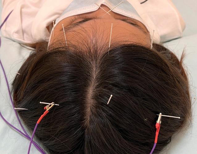 针灸头顶后的不良后果