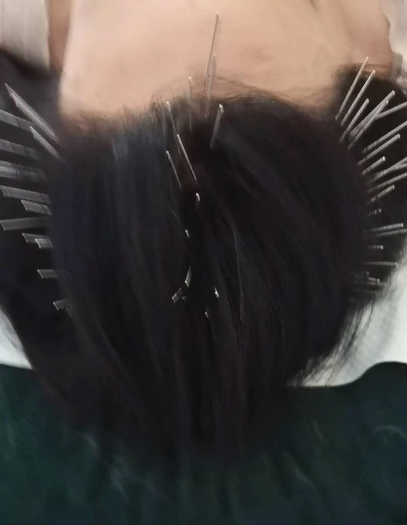 针灸头顶后的不良后果