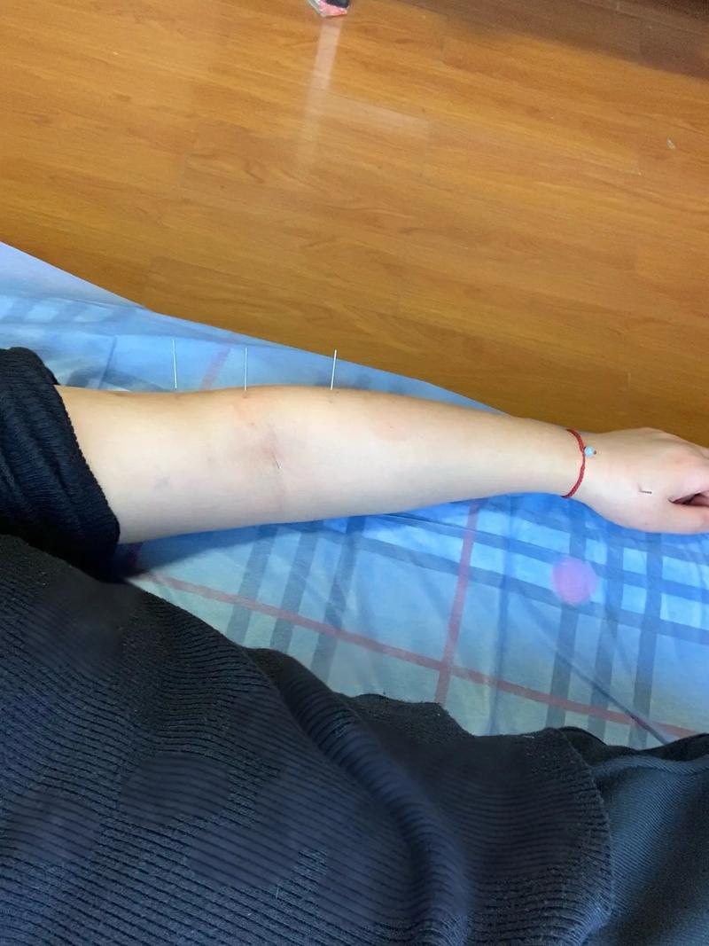 做完针灸后酸疼怎么办