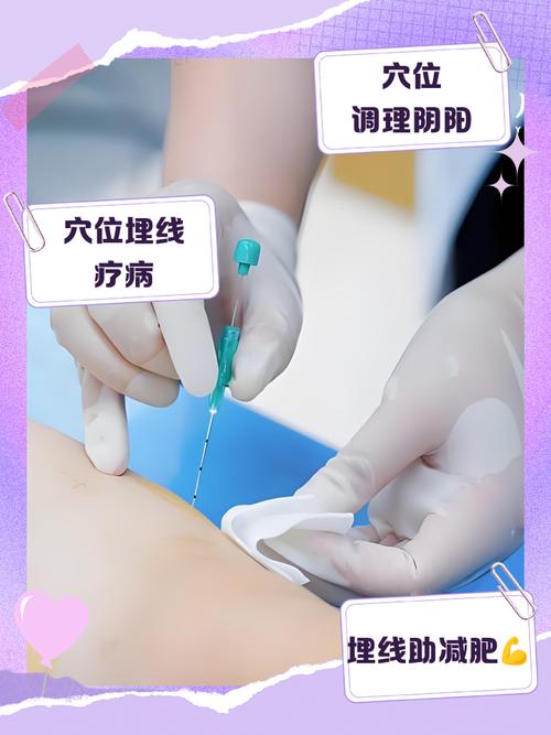 针灸埋线减肥有危害吗