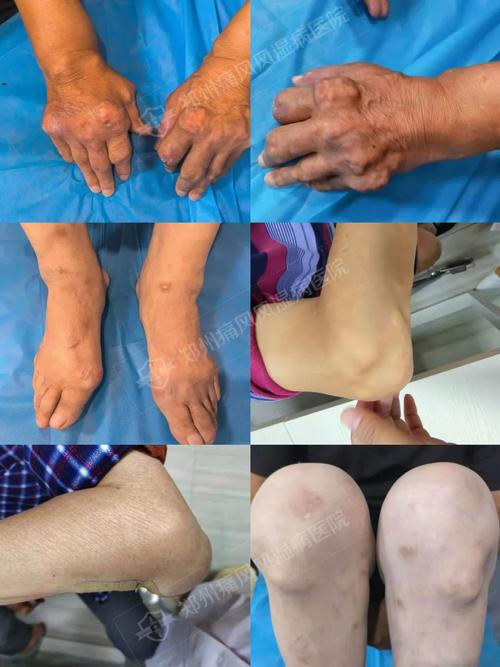 郑州国医堂医院 痛风