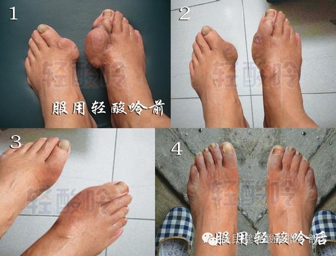 美国麒麟药厂 痛风治