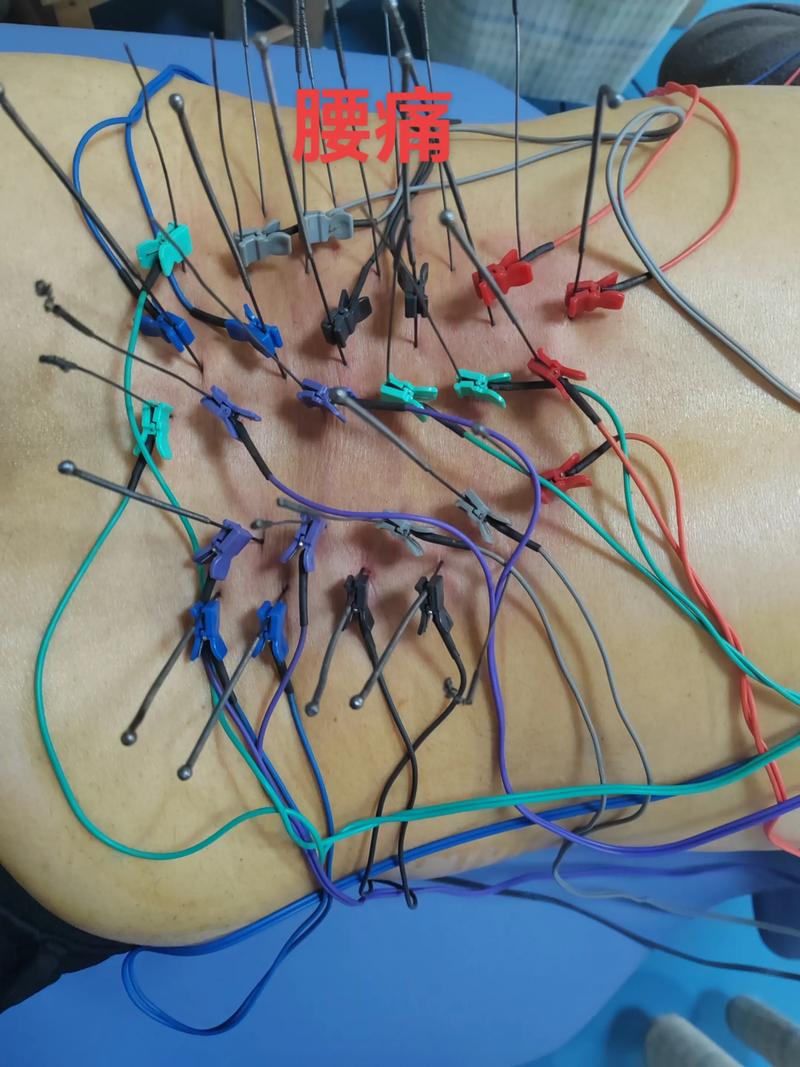 针灸腰椎间盘突出原理