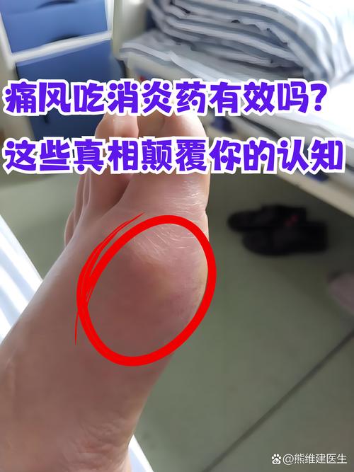 痛风急性发作治疗激素