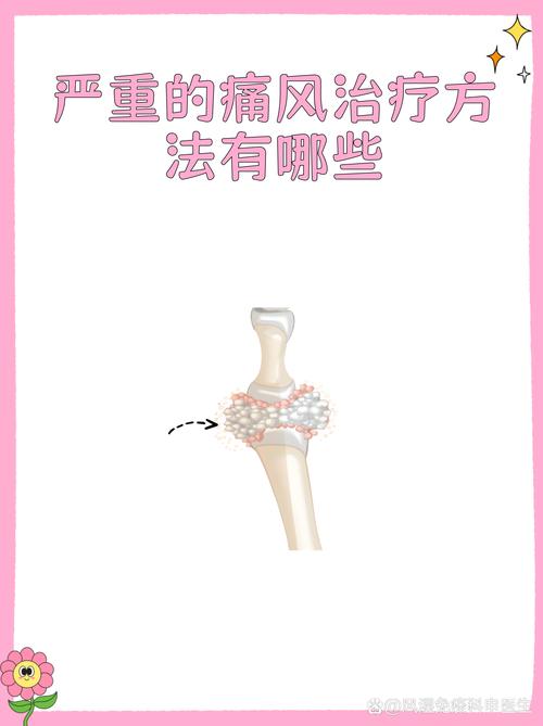 痛风急性发作治疗激素