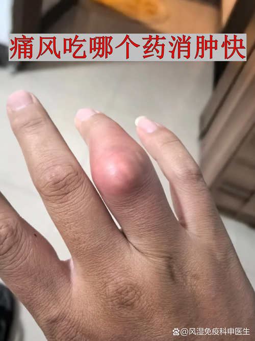 痛风怎样快速止痛消肿