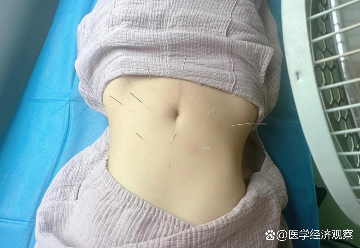 拉肚子针灸效果怎么样