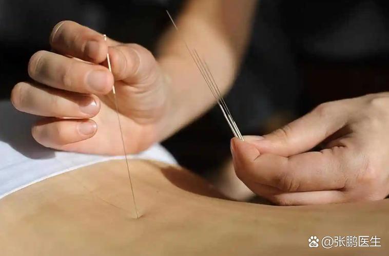 拉肚子针灸效果怎么样
