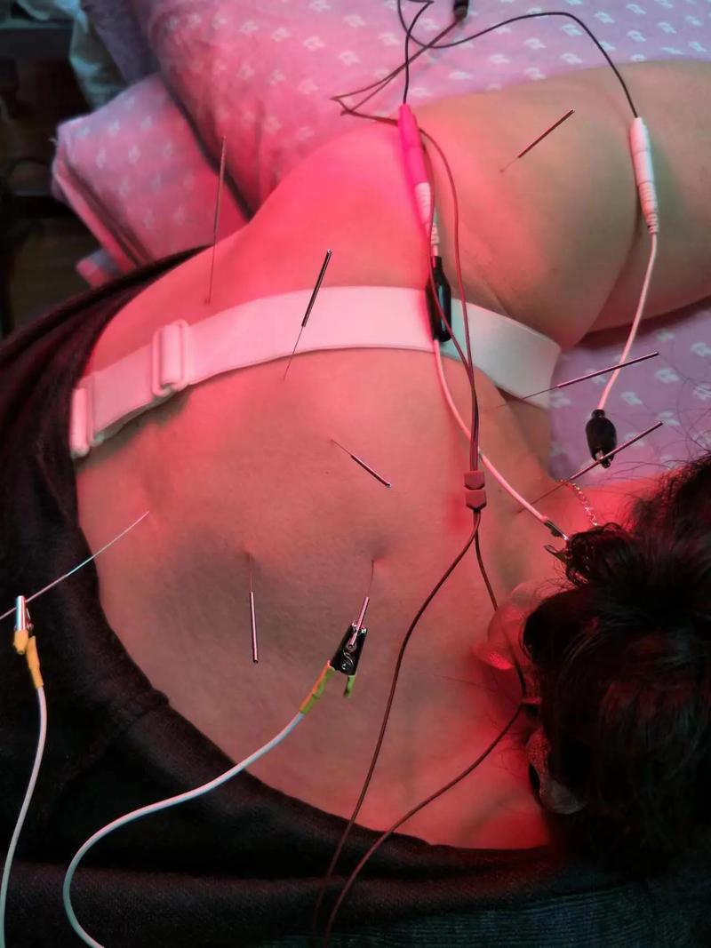 大屁股上扎针灸的视频