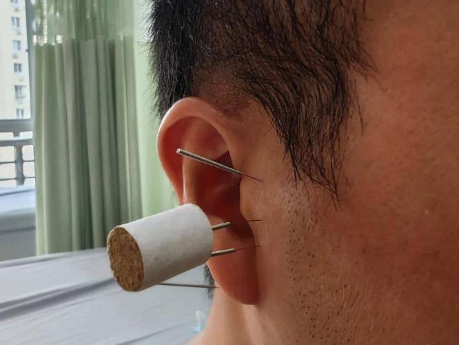 针灸治好了神经性耳鸣