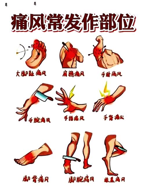 痛风发作时是怎么疼的