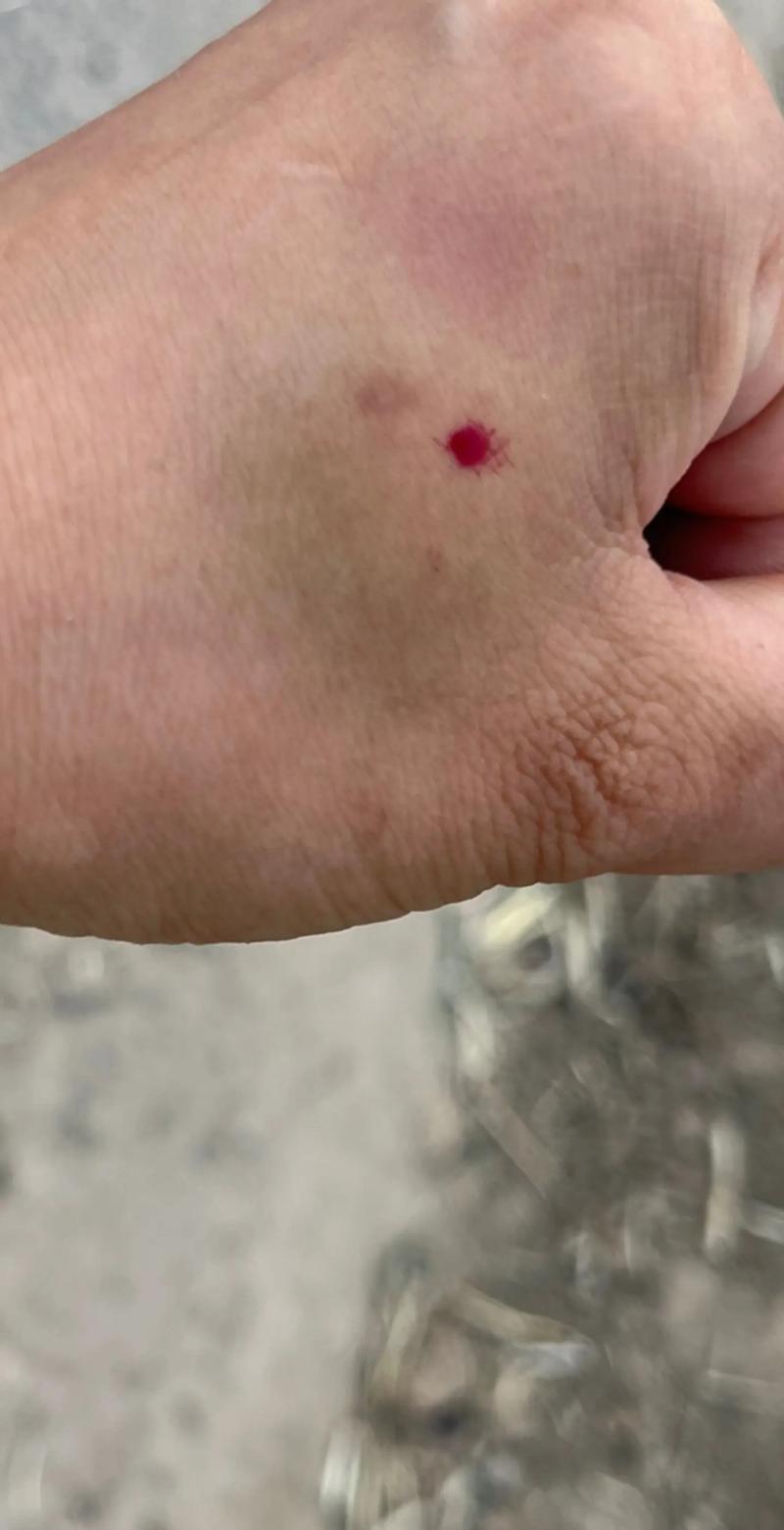 针灸的地方青了正常吗