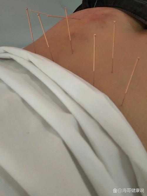 针灸的地方青了正常吗