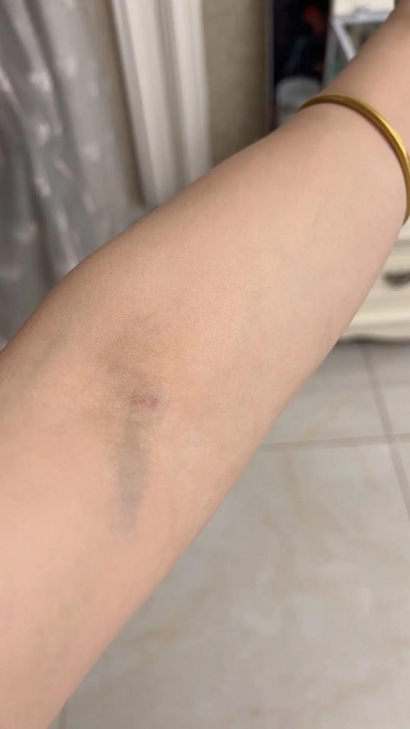 针灸的地方青了正常吗