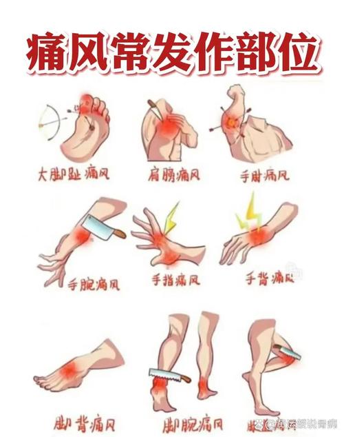 痛风是在脚的哪个位置