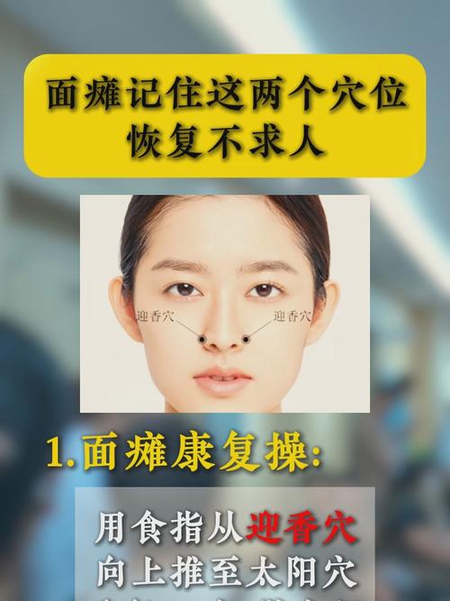 面瘫针灸患侧还是健侧