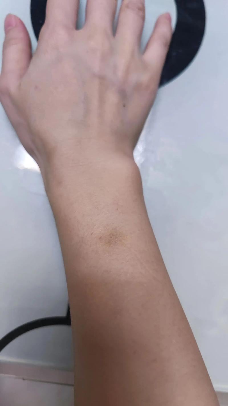 针灸后针眼痒怎么回事